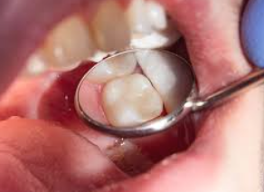 TAMBALAN GIGI BELAKANG